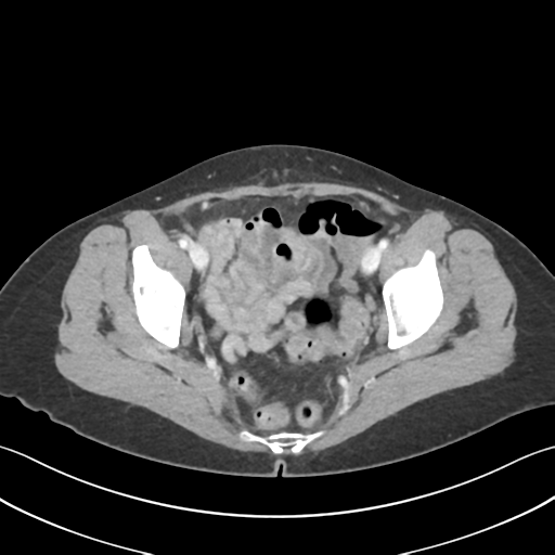 Cecum hernia through the foramen of Winslow (Radiopaedia 46634-51112 A 64).png
