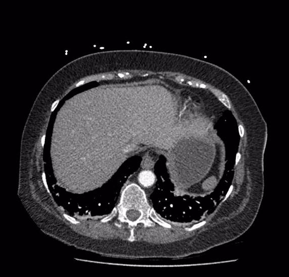 Celiac artery severe stenosis and dissection (Radiopaedia 44128-47842 B 5).jpg