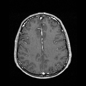 Central-variant posterior reversible encephalopathy syndrome (PRES) (Radiopaedia 43880-47358 Axial T1 C+ 115).jpg