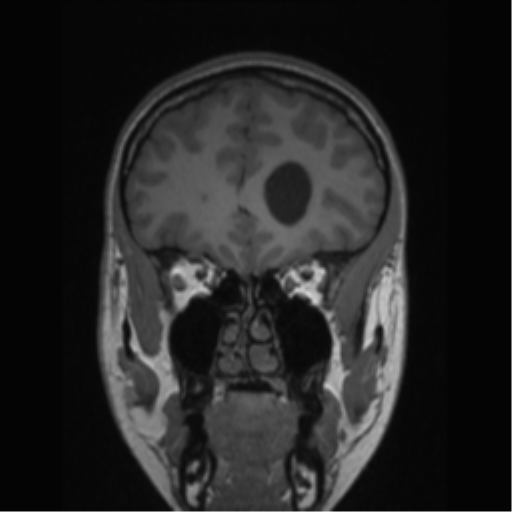 Central neurocytoma (Radiopaedia 37664-39557 Coronal T1 68).png