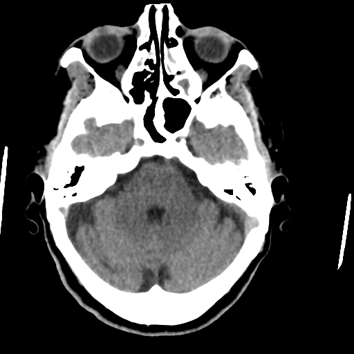 File:Central neurocytoma (Radiopaedia 65317-74346 Axial non-contrast 14).png