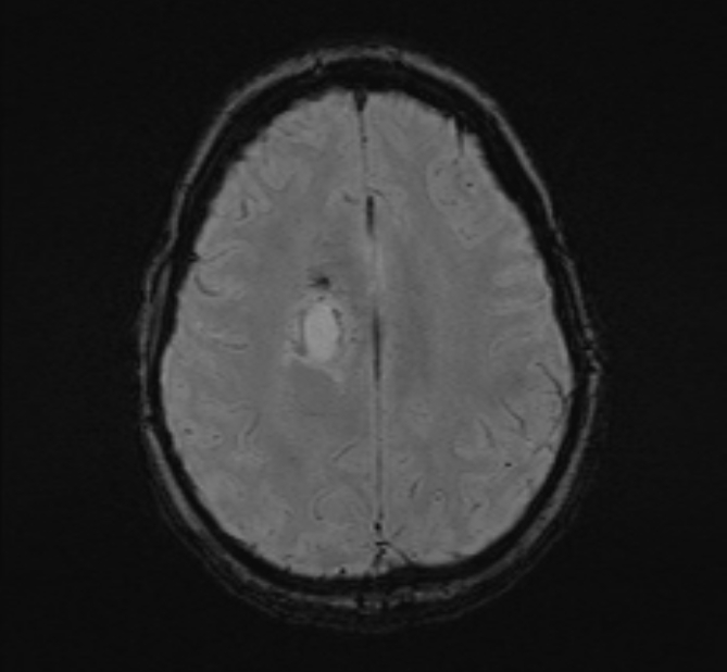 Central neurocytoma (Radiopaedia 70263-80336 Axial SWI 44).jpg