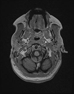 Central neurocytoma (Radiopaedia 84497-99872 Axial T1 28).jpg