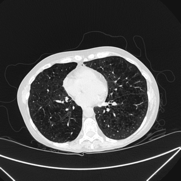 Centrilobular pulmonary emphysema (Radiopaedia 24495-24789 Axial lung window 60).jpg