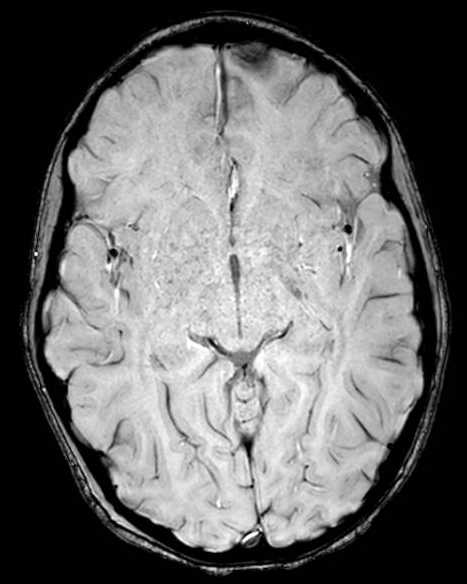 Cerebellar abscess (Radiopaedia 73727-84563 Axial SWI 34).jpg