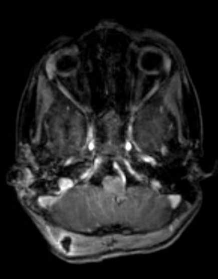 Cerebellar abscess (Radiopaedia 73727-84563 Axial T1 C+ fat sat 40).jpg