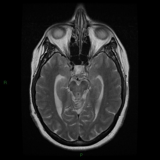 File:Cerebellar abscess (Radiopaedia 78135-90678 Axial T2 13).jpg