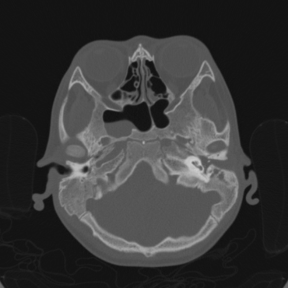 Cerebellar abscess secondary to mastoiditis (Radiopaedia 26284-26413 Axial bone window 43).jpg