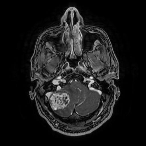 File:Cerebellar hemangioblastoma (Radiopaedia 88055-104622 Axial T1 C+ 40).jpg