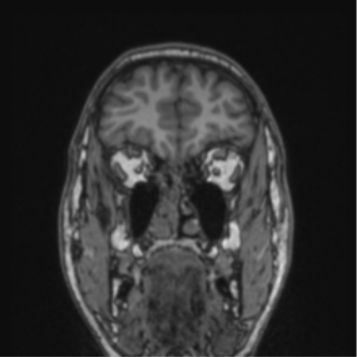 Cerebellar hemangioblastomas and pituitary adenoma (Radiopaedia 85490-101176 Coronal T1 72).png