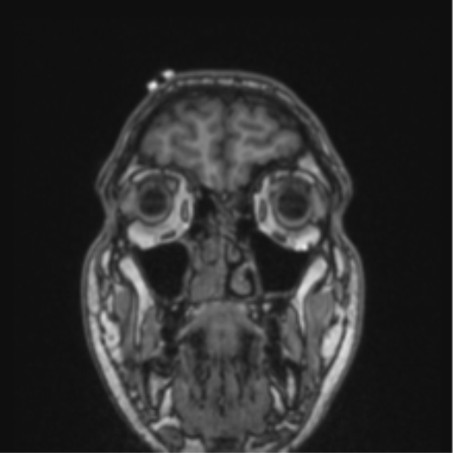Cerebellar hemangioblastomas and pituitary adenoma (Radiopaedia 85490-101176 Coronal T1 78).png