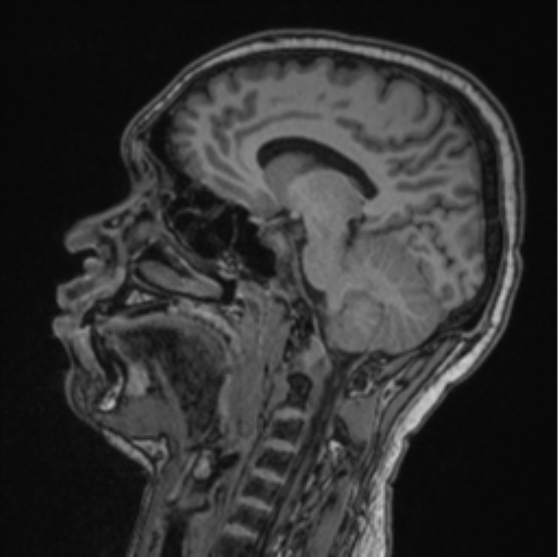Cerebellar hemangioblastomas and pituitary adenoma (Radiopaedia 85490-101176 Sagittal T1 48).png