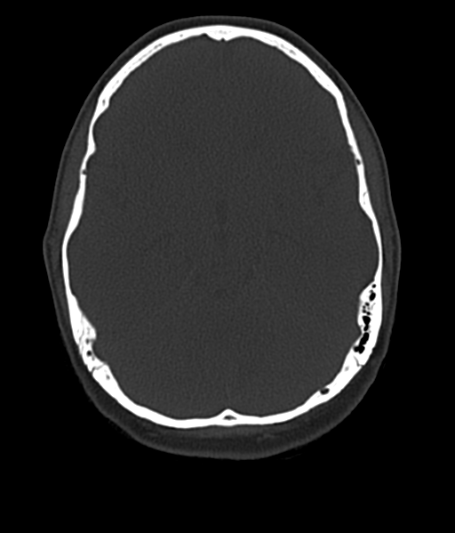 File:Cerebellar metastases - colorectal adenocarcinoma (Radiopaedia 40947-43652 AX Bone C- 2.0 MPR 23).png