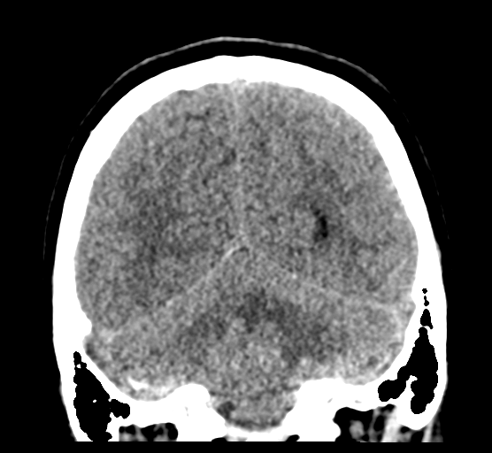 Cerebellar metastases - colorectal adenocarcinoma (Radiopaedia 40947-43652 Coronal non-contrast 70).png
