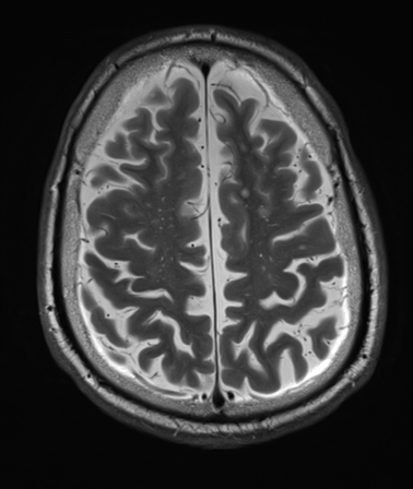 File:Cerebellar metastasis (Radiopaedia 33616-34718 Axial T2 31).png
