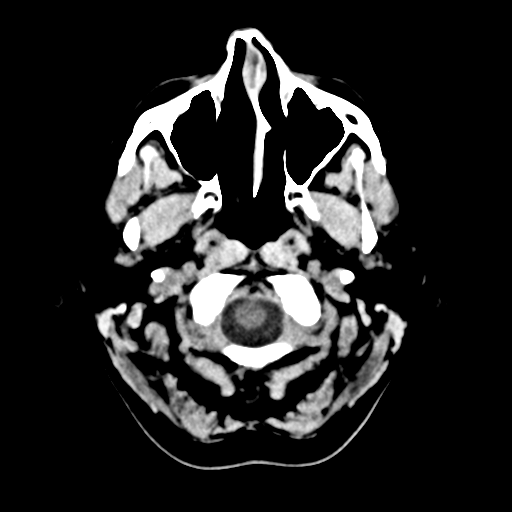 Cerebellar metastasis (Radiopaedia 54578-60812 Axial non-contrast 3).png