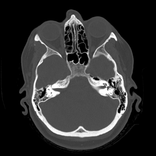 Cerebellar metastasis (cystic appearance) (Radiopaedia 41395-44258 Axial bone window 16).png