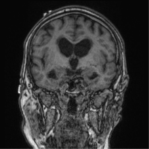 Cerebellar metastasis from lung adenocarcinoma (Radiopaedia 86690-102829 Coronal T1 58).png