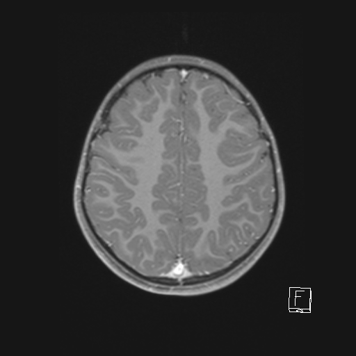 Cerebellar stroke (Radiopaedia 32202-33150 Axial T1 C+ 52).png