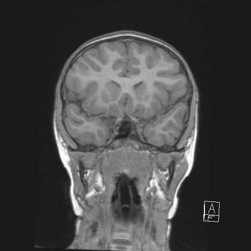 Cerebellar stroke (Radiopaedia 32202-33150 Coronal T1 22).png