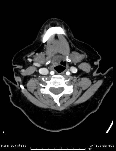 Cerebellar strokes due to intracranial giant cell arteritis (Radiopaedia 68799-78510 CT angiogram 107).jpg