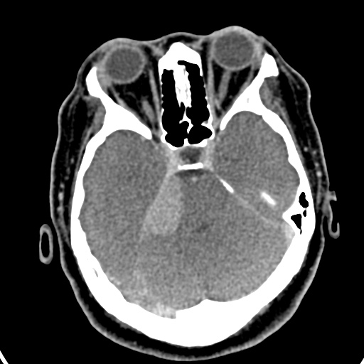 Cerebellopontine angle meningioma (Radiopaedia 35181-36714 A 15).jpg