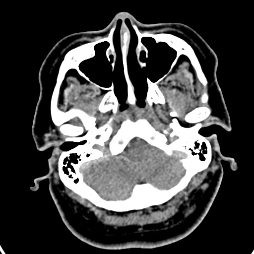 Cerebellopontine angle meningioma (Radiopaedia 35181-36714 A 45).jpg