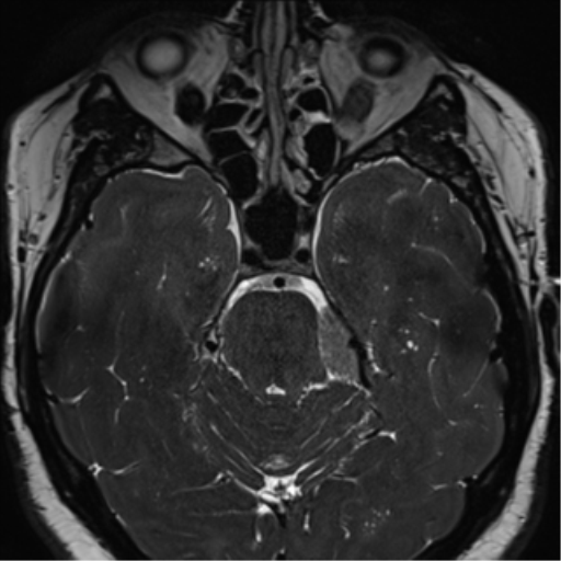 Cerebellopontine angle meningioma (Radiopaedia 48434-53348 Axial T2 Space 80).png