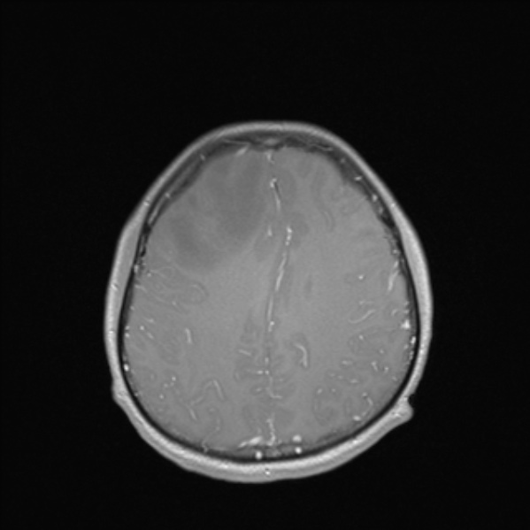 File:Cerebral abscess (Radiopaedia 24212-24478 Axial T1 C+ 44).jpg