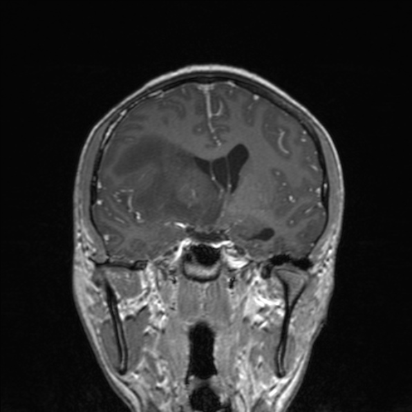 Cerebral abscess (Radiopaedia 24212-24478 Coronal T1 C+ 101).jpg