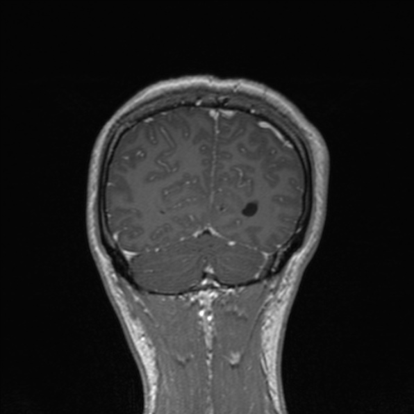 Cerebral abscess (Radiopaedia 24212-24478 Coronal T1 C+ 167).jpg