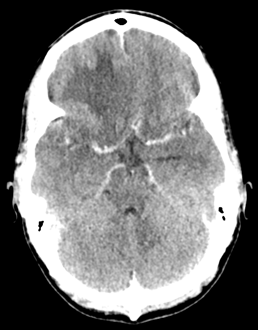 Cerebral abscess (Radiopaedia 60342-68008 Axial C+ delayed 18).png