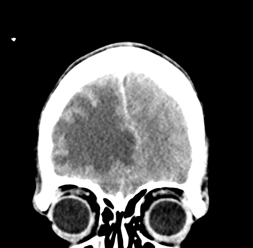 Cerebral abscess (Radiopaedia 60342-68008 Coronal C+ delayed 13).png