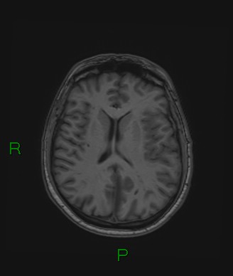 Cerebral abscess and subdural empyema (Radiopaedia 84436-99779 Axial T1 37).jpg