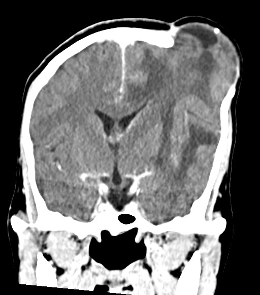 Cerebral abscesses (Radiopaedia 70458-80568 Coronal Contrast 30).jpg