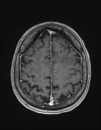 Cerebral amyloid angiopathy-related inflammation (Radiopaedia 58270-65377 Axial T1 C+ fat sat 114).jpg