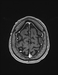 Cerebral amyloid angiopathy-related inflammation (Radiopaedia 58270-65377 Axial T1 C+ fat sat 130).jpg