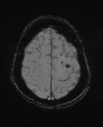 File:Cerebral amyloid angiopathy-related inflammation (Radiopaedia 74836-85849 Axial SWI 58).jpg