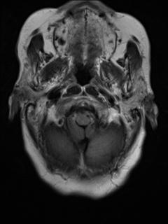 File:Cerebral amyloid angiopathy (Radiopaedia 29129-29518 Axial FLAIR 2).jpg