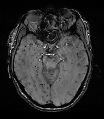 File:Cerebral amyloid angiopathy (Radiopaedia 46082-50433 Axial SWI 32).png