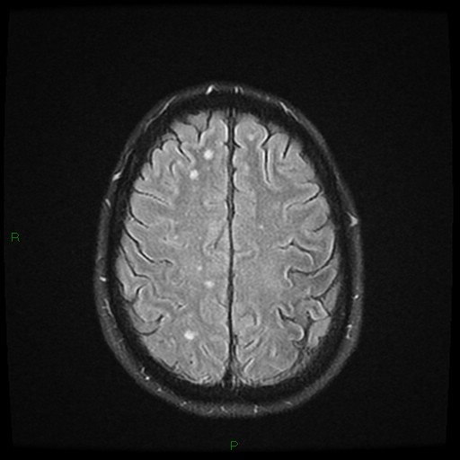 File:Cerebral amyloid angiopathy (Radiopaedia 77506-89664 Axial FLAIR 22).jpg