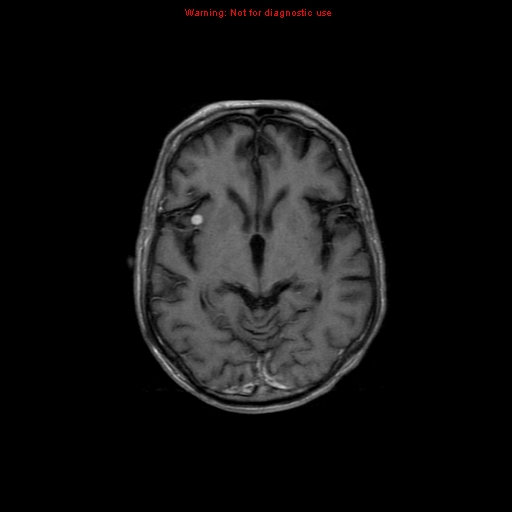 File:Cerebral and orbital tuberculomas (Radiopaedia 13308-13311 Axial T1 C+ 10).jpg