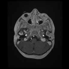 Cerebral and spinal tuberculosis (Radiopaedia 90489-107837 Axial T1 C+ 49).jpg