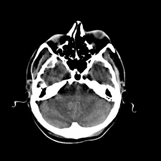 Cerebral arteriovenous malformation (Radiopaedia 28518-28759 Axial non-contrast 17).jpg