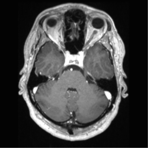 File:Cerebral arteriovenous malformation (Radiopaedia 39259-41506 AX T1 MPR C+ 19).png
