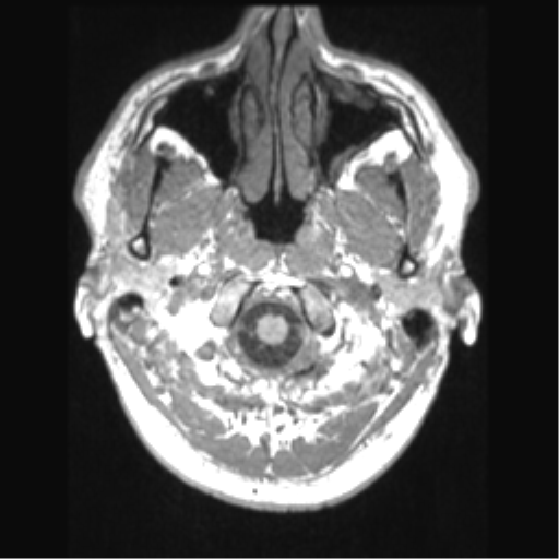Cerebral arteriovenous malformation (Radiopaedia 39259-41506 Axial T1 7).png