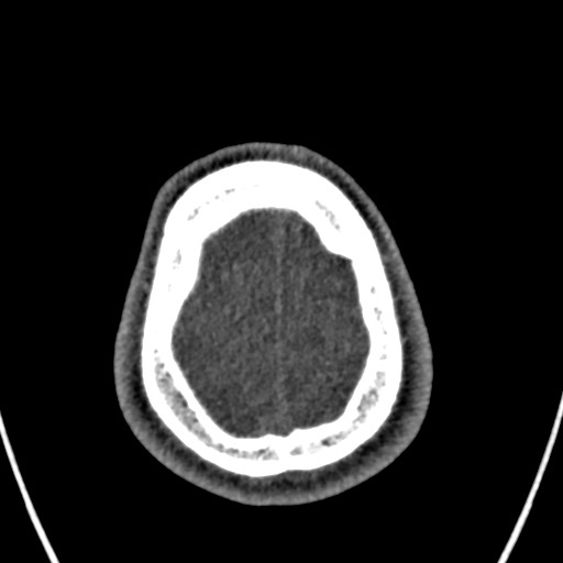 File:Cerebral arteriovenous malformation (Radiopaedia 78188-90746 Axial non-contrast 163).jpg