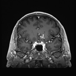 Cerebral arteriovenous malformation (Radiopaedia 84015-99245 Coronal T1 C+ 59).jpg