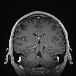 Cerebral arteriovenous malformation (Radiopaedia 84015-99245 Coronal T1 C+ 97).jpg