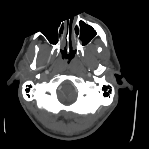Cerebral arteriovenous malformation (Spetzler-Martin grade 2) (Radiopaedia 41262-44076 E 6).png